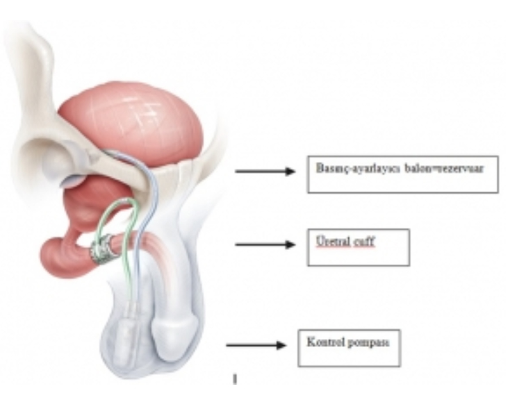 Artifisyel Üriner Sfinkter (Yapay İdrar Tutucu)